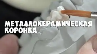 Металлокерамическая коронка