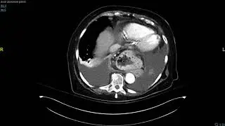 Brown Clinical Image of the Month: Lambls 1