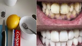 2 Dakika İçinde Sarı Dişlere Çözüm - İnci Gibi Beyaz Dişlere Nasıl Sahip Olunur ?  limon, tuz, macun