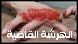 الهرشة القاضية
