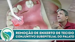 Aprenda a remover enxertos de tecido conjuntivo de uma vez