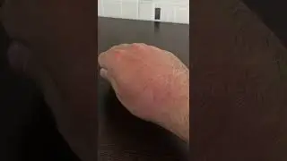 Как избавиться от укуса шмеля. Последствия укуса