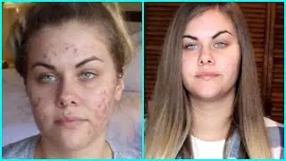 My Acne Story + Secrets to Clear Skin |
