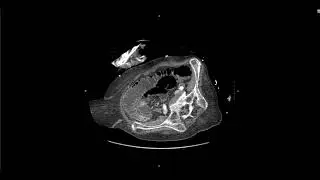 Abdominal Imaging Call Prep Cases: C​l​o​s​e​d​ ​L​o​o​p​ ​SBO (CT) Case 2 Discussion