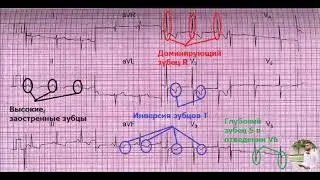 ЭКГ номер 9 - заключение, клиническая интерпретация и что делать