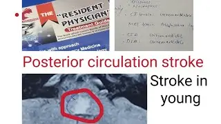 Posterior Circulation stroke "Medullary infarct one of the most dangerous stroke