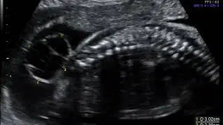 Ultrasonografía en mielomeningocele fetal