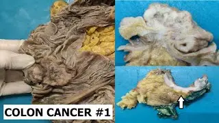 Colon cancer grossing #1