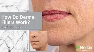 How do dermal fillers work?