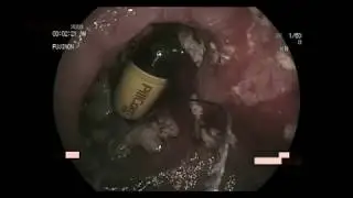RESCUE OF RETAINED VIDEO CAPSULE USING DBE