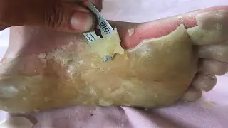 How to removal skin | callus removal skin flakes #33