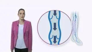 Хроническая венозная недостаточность