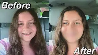I GOT BRACES!