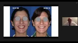 Resolución de casos complejos en Ortodoncia con Mini implantes Dr. Eduardo Moran
