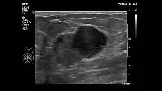 breast cancer(palpable mass)