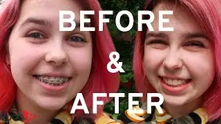 Braces OFF! Before & After | RadioJH Audrey