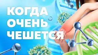 ЛЕЧЕНИЕ ПСОРИАЗА / КАК ИЗБАВИТЬСЯ ОТ ШЕЛУШЕНИЙ КОЖИ?