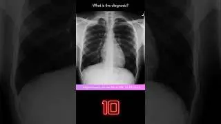 Chest X-ray Quiz 4 (explanation with overlays)