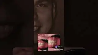 Мы можем так: брекеты-виниры-счастье🥹 #ортодонт #брекеты #стоматолог #виниры #остеопат #элайнеры