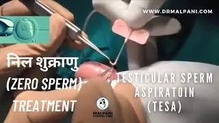 Testicular Sperm Extraction (TESA) | ICSI | Azoospermia |Explained in Hindi