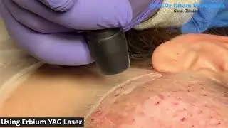 Don't Pop Your Acne! This Laser is the Answer to CLEAR Skin #acnescars #lasertherapy