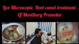 Step by step Live Microscopic Root canal treatment of Maxillary Premolar#rct for beginners#Rct
