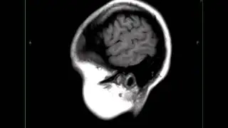 Cortical Dysplasia