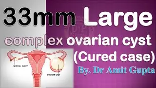 Complex ovarian Cyst।।33mm large right ovarian cyst।। (Cured case)