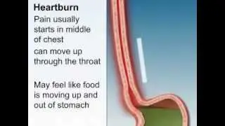 What Are the Symptoms of GERD?