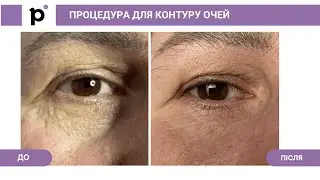 Процедура для контуру очей