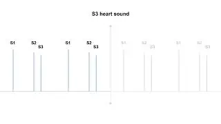 S3 Heart Sound for USMLE.