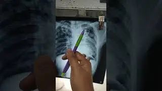chest xray of pulmonary tuberculosis