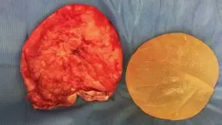 Dr. Sean Rice, Toronto Plastic Surgeon, explains En Bloc Removal of Breast Implants