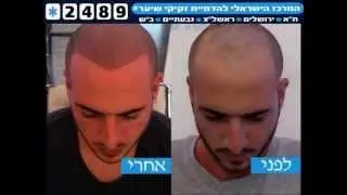 גבר, קעקוע של זקיקי שיער בקרחת ניסית כבר? הדמיית שיער בHair City