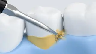 Xiaomi Tooth Calculus Remover // Aliexpress