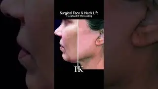 Surgical Face & Neck Lift Before and After by Dr. Khorasani | NYC