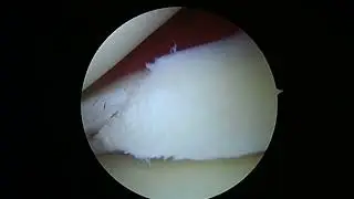 Left knee partial medial menisectomy 3.2.23 LE (dallas)