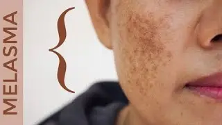 Laser treatment for pigmentation || elocon cream || झाईयों का लेजर उपचार | झाईयां