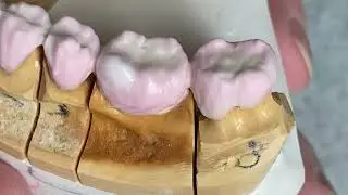 Lower 12 Unit PFM Simple Buildup For Beginners