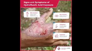 First Aid for Hydrofluoric Acid Burns