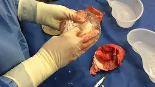 En Bloc Explant of 30 year old breast implants.