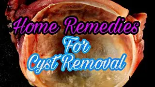 7 Home Remedies for Cysts|Natural|Knowledge Madnoob
