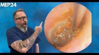 Giant Ear Wax Removal - Eardrum Skin Peel - MEP24