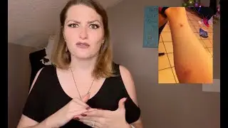 Jungle Bruise | Cast Member Injuries