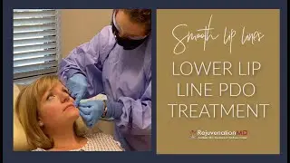 Smooth Lip Lines with PDO Threads