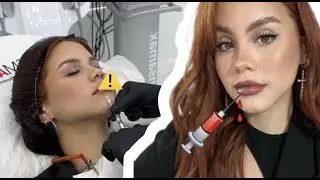 ME INYECTÉ LOS LABIOS 💉👄 *y grabé todo el proceso*