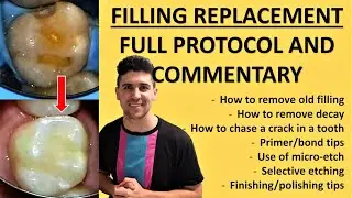 Old Fillings And Decay Near A Crack (Class II Resin Filling Replacement) | Fillings Case #1