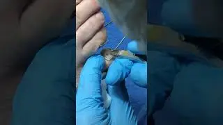 Удаление стержневой мозоли