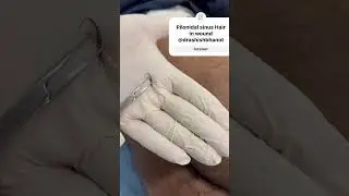 Hair in Pilonidal Sinus 
