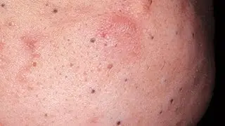 Маска от расширенных пор и черных точек